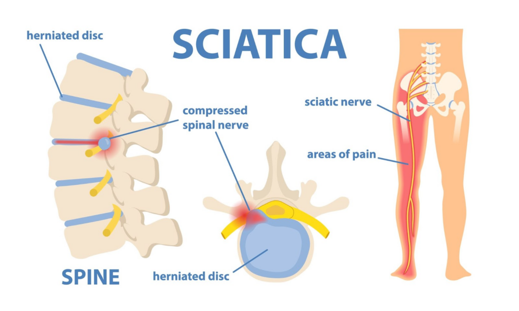 What Is The Best Sleeping Position For Sciatica?